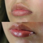 Vitamine E - Verdikkende Lippen Serum - 1+1 Gratis!