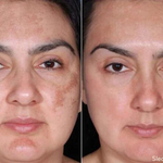 SkinShine - Huidverhelderende Gezichtsserum - 1+1 Gratis!
