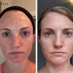 SkinShine - Huidverhelderende Gezichtsserum - 1+1 Gratis!