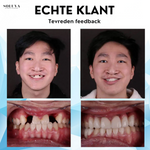 Siliconen Reline Gebitset - 1+1 Gratis!
