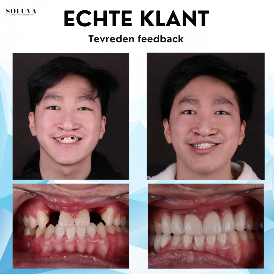 Siliconen Reline Gebitset - 1+1 Gratis!