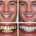 Teeth Essence - Ultra Sterke Tandenbleker - 1+2 Gratis!