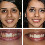 Teeth Essence - Ultra Sterke Tandenbleker - 1+2 Gratis!
